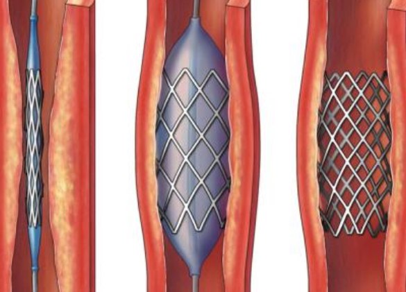 好消息！700元冠脈支架來了帶量采購結(jié)果在甘肅省正式落地執(zhí)行